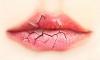 Сохнут губы — из-за чего это происходит у женщин и мужчин?